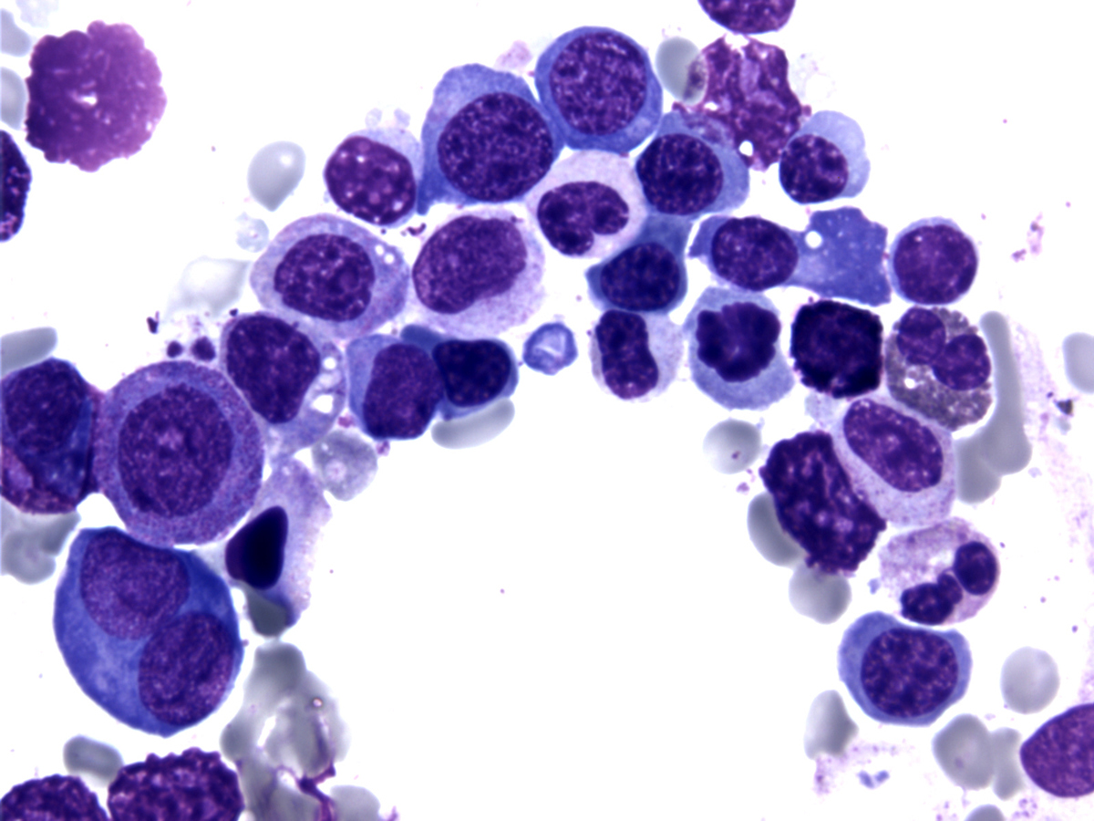 Bone marrow aspirate smear (BM-1), Wright-Giemsa stain, A, x1000